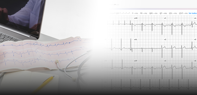 Comparação visual entre ECG Digital e ECG de Fita mostrando diferenças no traçado e formato de registro